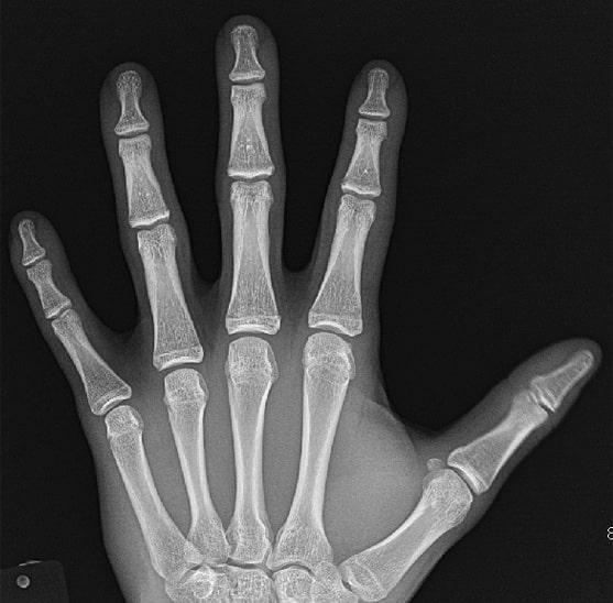 growth plate fractures.