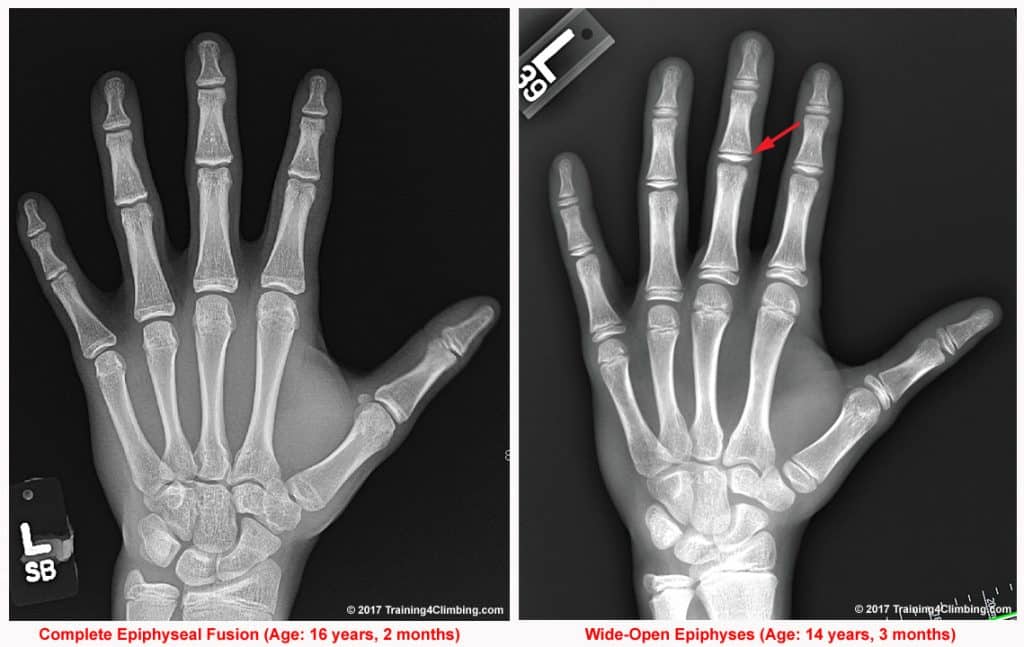 growth plate injury youth climbers