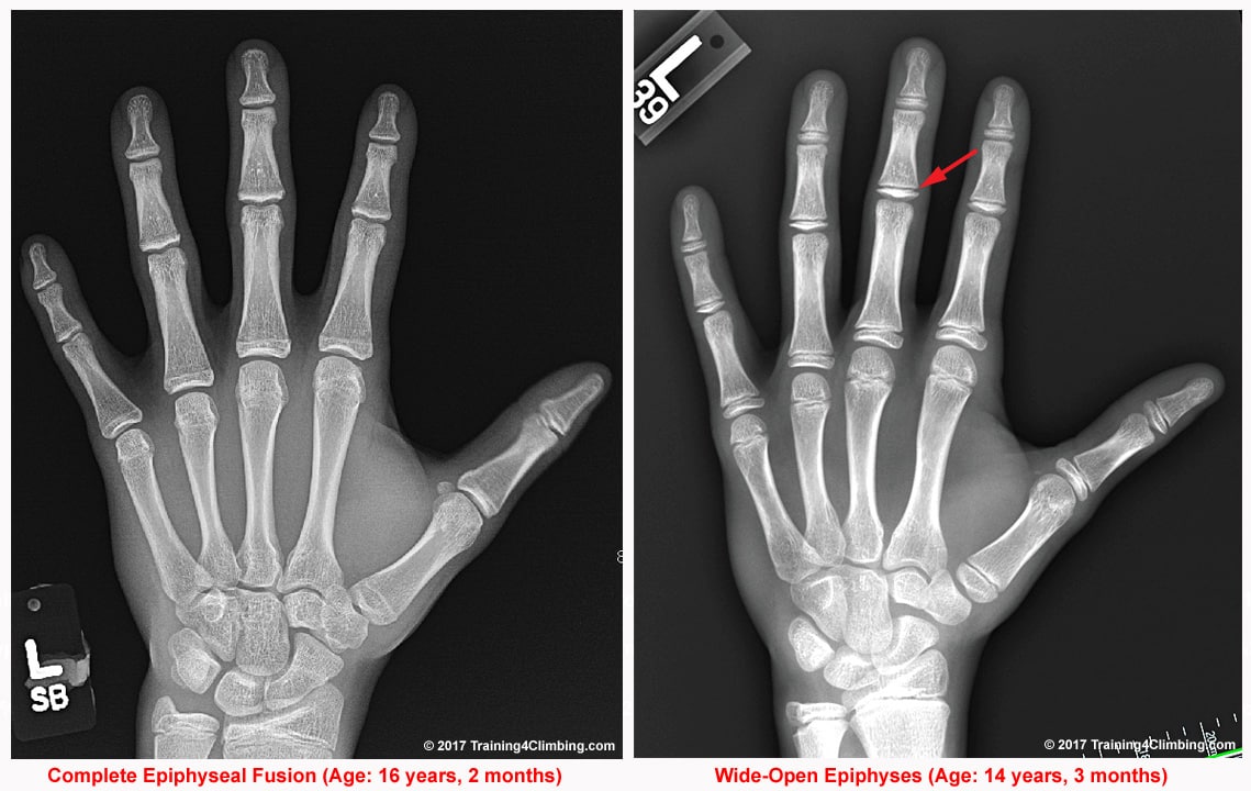 Reducing Risk Of Growth Plate Fractures In Youth Climbers