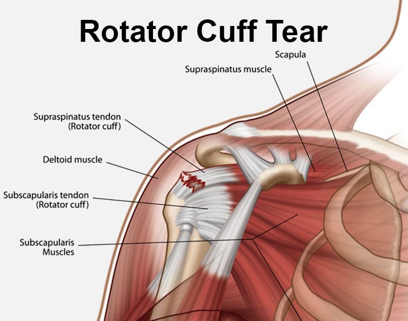 Functional Outcome After Surgical Repair of Rotator Cuff Tears in Rock Climbers