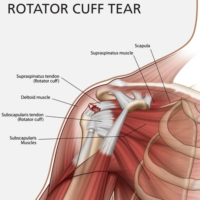 partially torn rotator cuff treatment